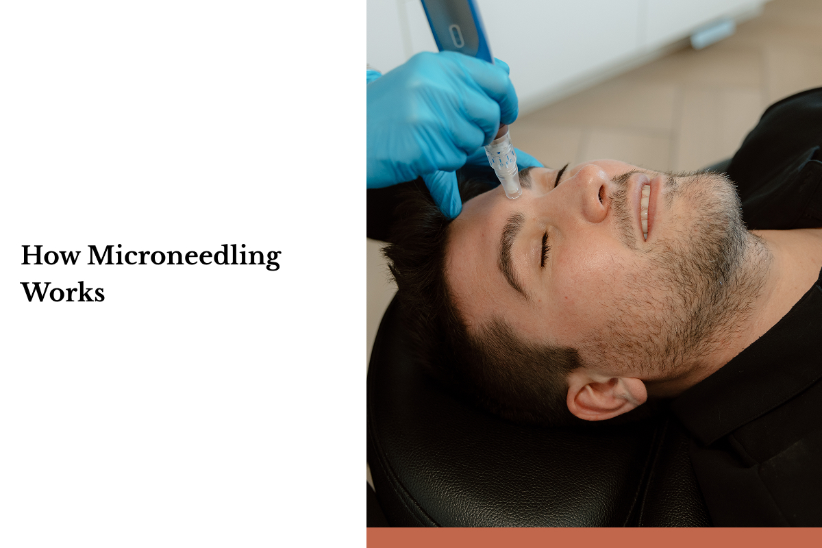 Form A man lies on a table and smiles as he undergoes microneedle treatment. Form Aesthetics is committed to helping you look your best.